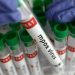 Sindh reports first case of mpox: health ministry